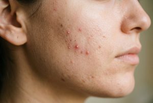 Acné : Quand consulter un dermatologue et comment le traiter ?